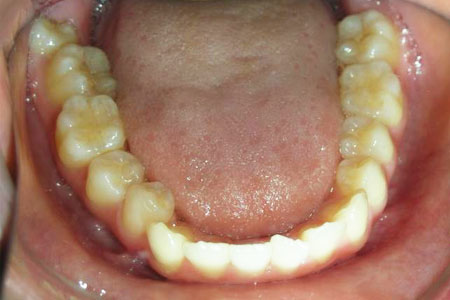 下顎前突その2　治療前下歯