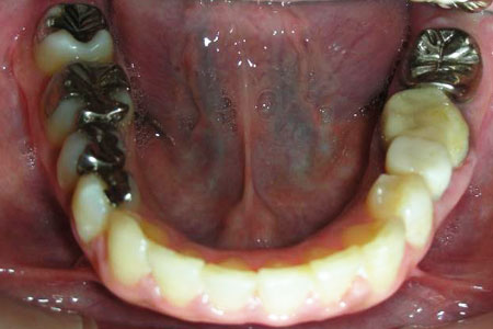 上顎前突治療その2　治療後下歯