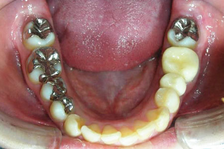 上顎前突治療その2　治療後下歯
