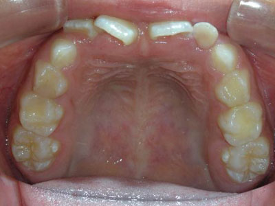 茶沢矯正歯科の早期矯正治療 筋機能矯正　治療例1