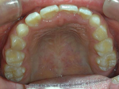 茶沢矯正歯科の早期矯正治療 筋機能矯正　治療例1