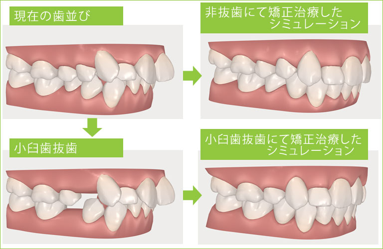iTero elementによる抜歯と非抜歯の矯正治療経過予想図